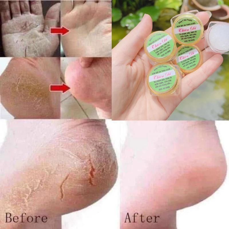 Kem Bôi Nứt Gót Chân Gia Truyền Thiên Di - Kem Bôi Chàm Cho Bé - Kem Chống Nẻ Hết Nứt Gót Chân Dưỡng Ẩm Da